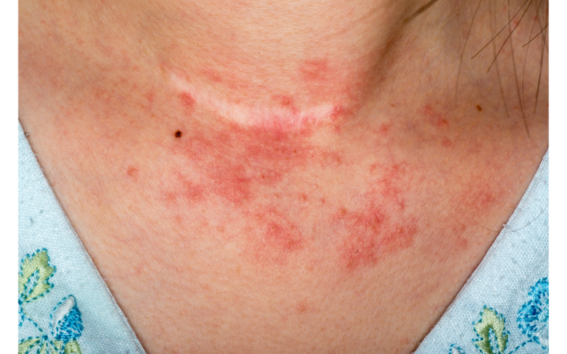 You are currently viewing Ekzeme, Neurodermitis oder der Psoriasis 